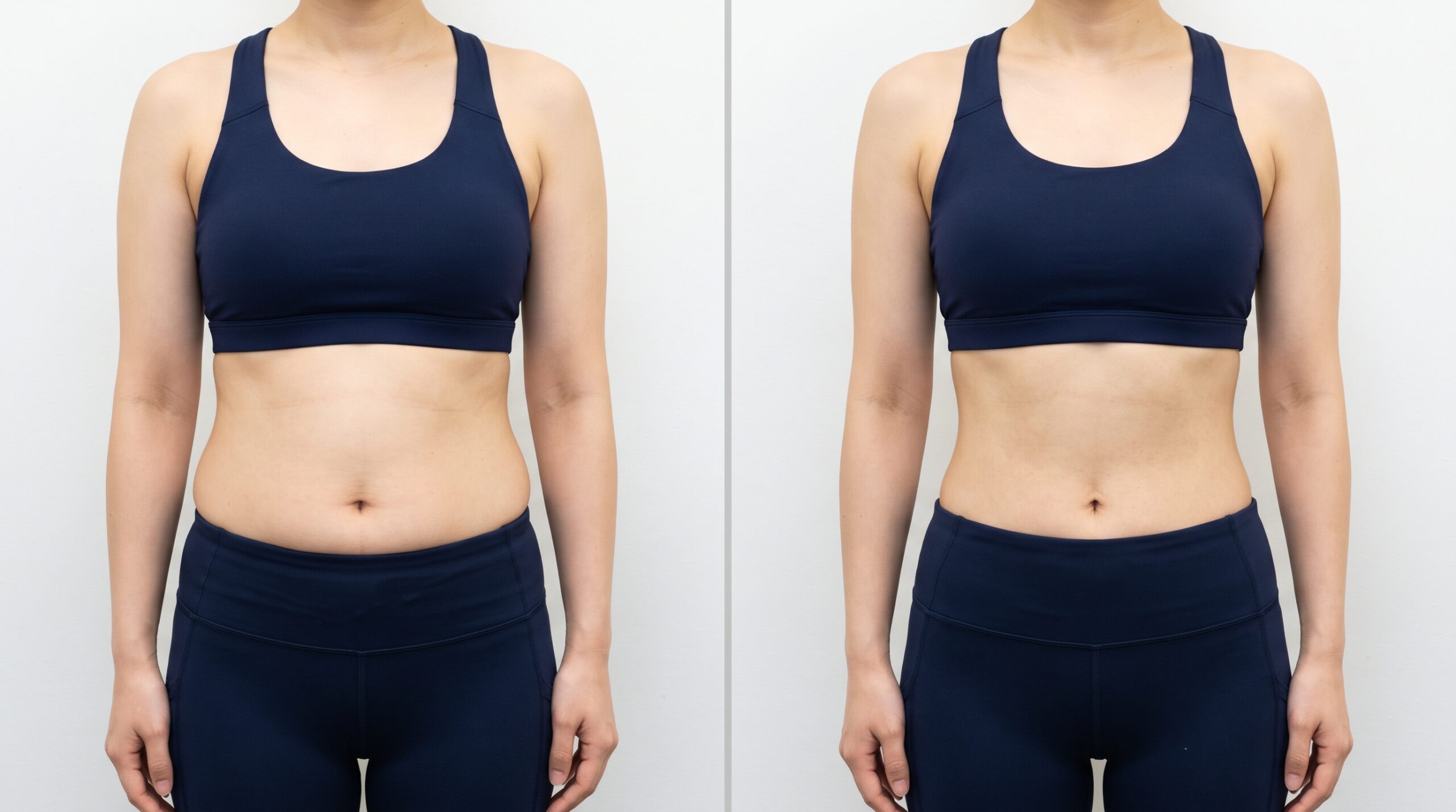 GLP-1ダイエット3ヶ月間によるお腹周りの変化